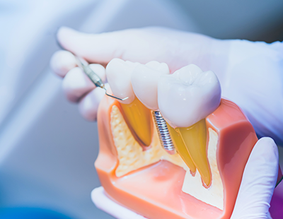 Dental Implants Dentist in Boro Park